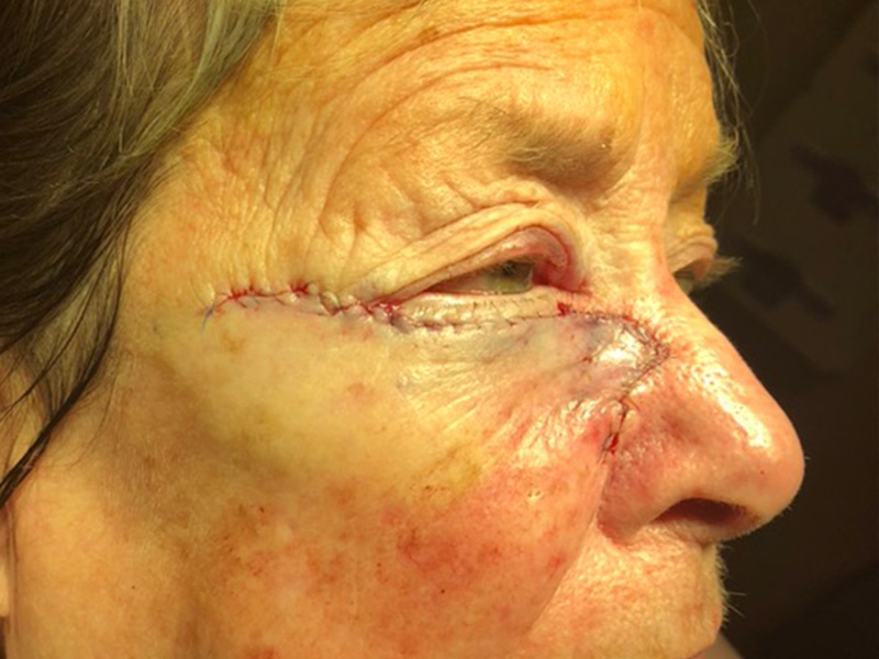 Skin Cancer Reconstruction Before and After | Montilla Plastic Surgery 