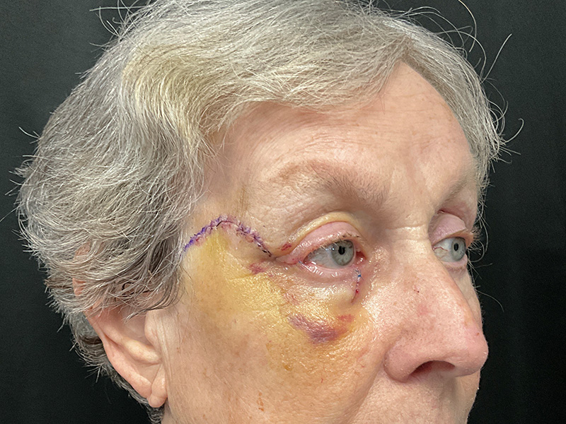 Skin Cancer Reconstruction Before and After | Montilla Plastic Surgery