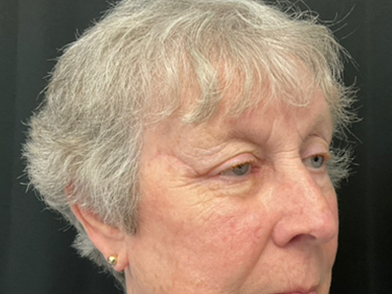 Skin Cancer Reconstruction Before and After | Montilla Plastic Surgery
