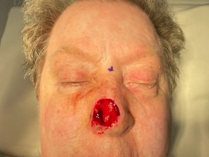 Skin Cancer Reconstruction Before and After | Montilla Plastic Surgery 