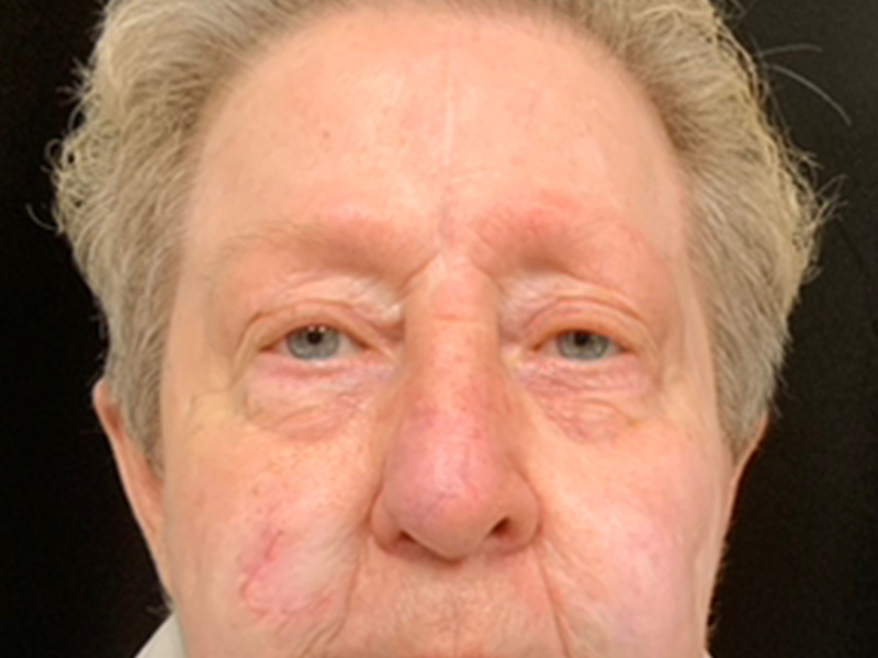 Skin Cancer Reconstruction Before and After | Montilla Plastic Surgery 