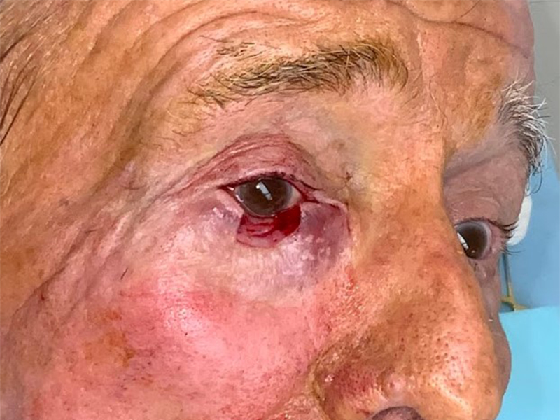 Skin Cancer Reconstruction Before and After | Montilla Plastic Surgery 
