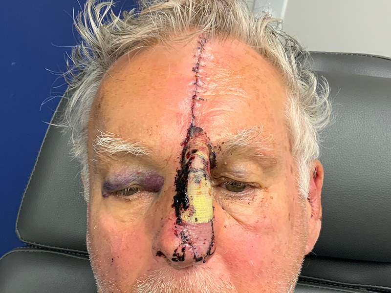 Skin Cancer Reconstruction Before and After | Montilla Plastic Surgery