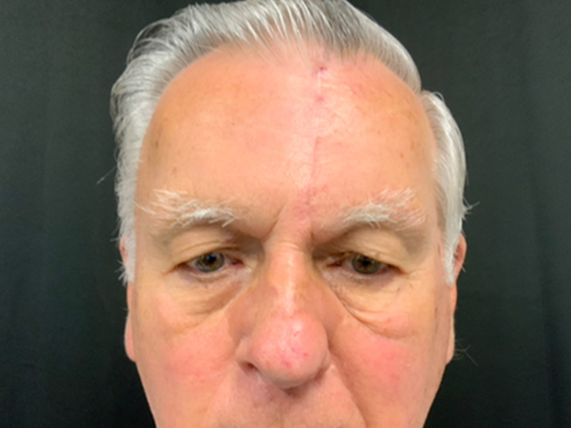 Skin Cancer Reconstruction Before and After | Montilla Plastic Surgery