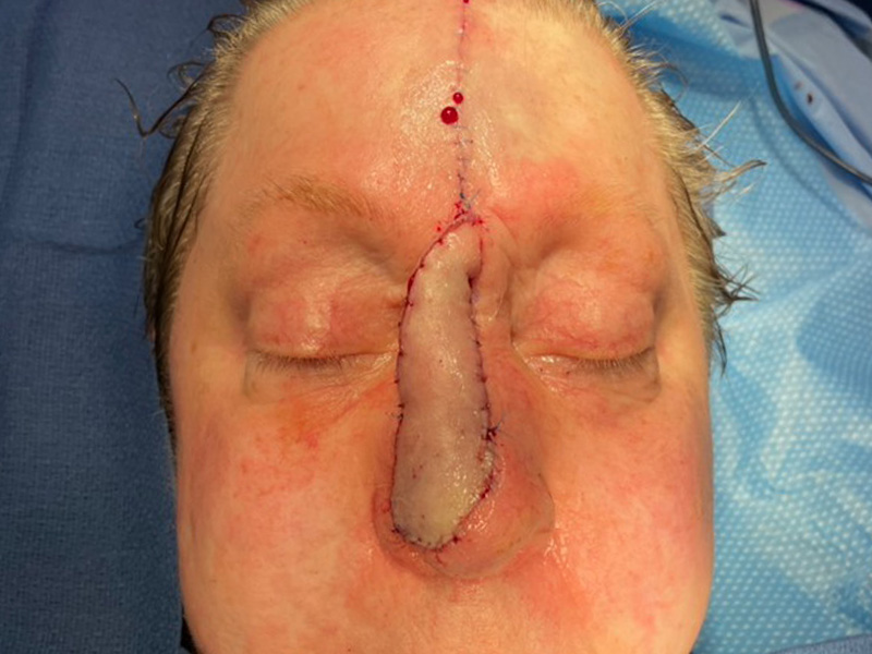 Skin Cancer Reconstruction Before and After | Montilla Plastic Surgery