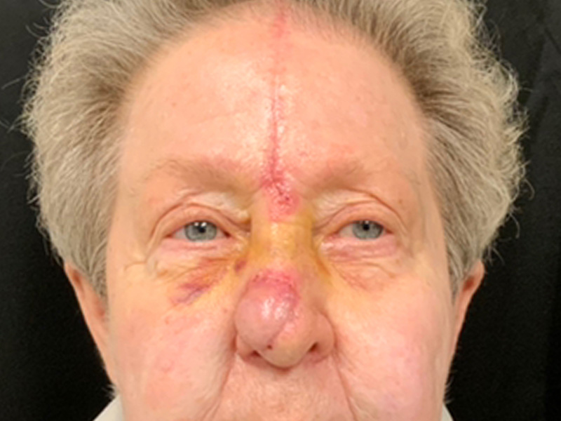 Skin Cancer Reconstruction Before and After | Montilla Plastic Surgery