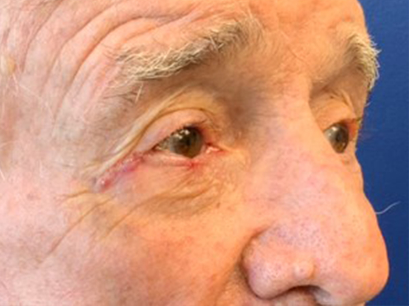 Skin Cancer Reconstruction Before and After | Montilla Plastic Surgery