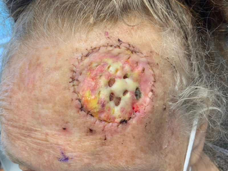 Skin Cancer Reconstruction Before and After | Montilla Plastic Surgery