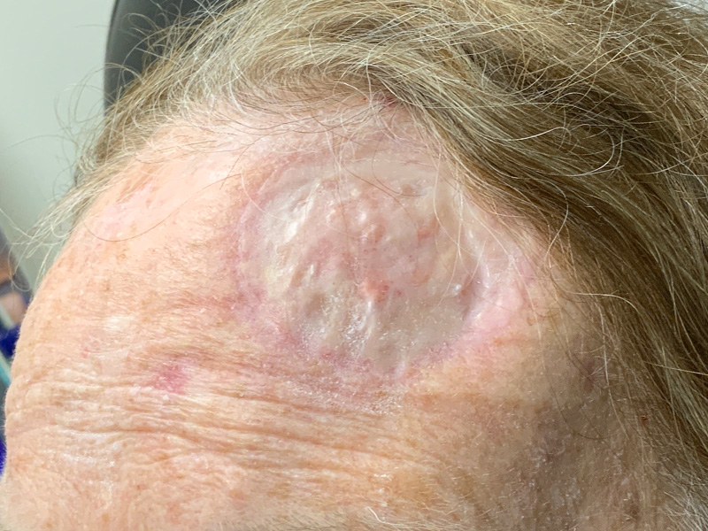 Skin Cancer Reconstruction Before and After | Montilla Plastic Surgery