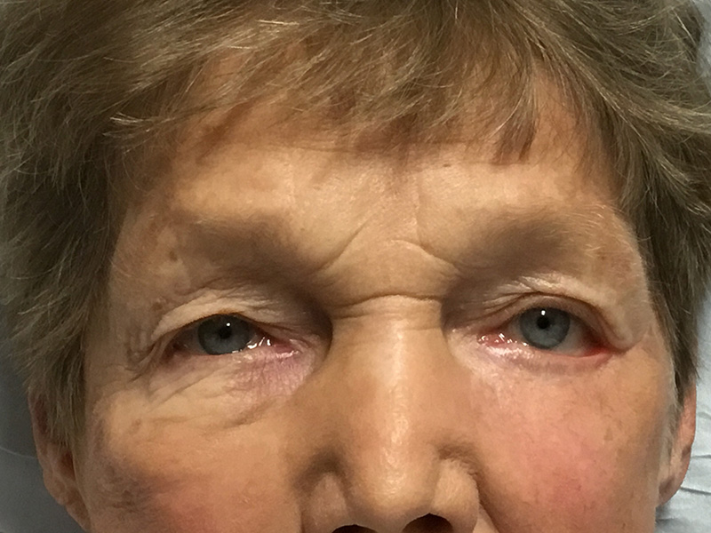 Skin Cancer Reconstruction Before and After | Montilla Plastic Surgery