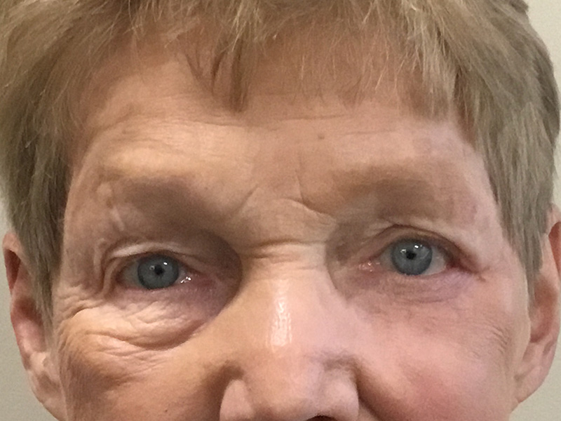 Skin Cancer Reconstruction Before and After | Montilla Plastic Surgery