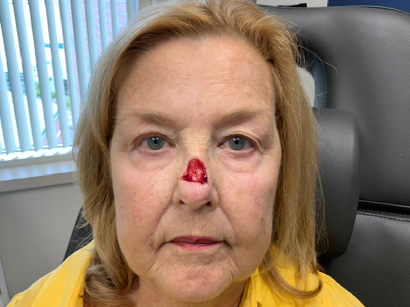 Skin Cancer Reconstruction Before and After | Montilla Plastic Surgery