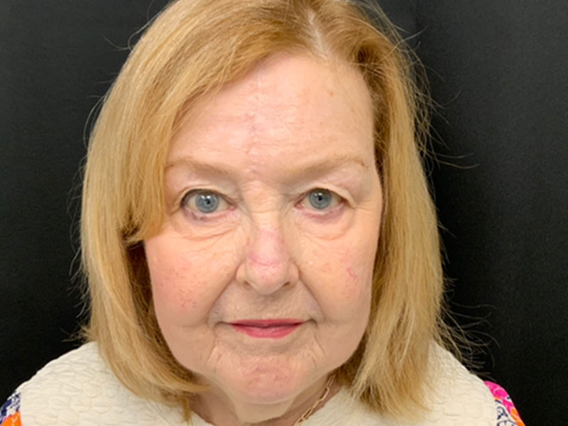 Skin Cancer Reconstruction Before and After | Montilla Plastic Surgery