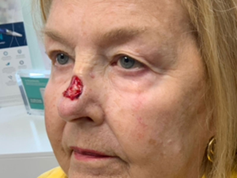 Skin Cancer Reconstruction Before and After | Montilla Plastic Surgery