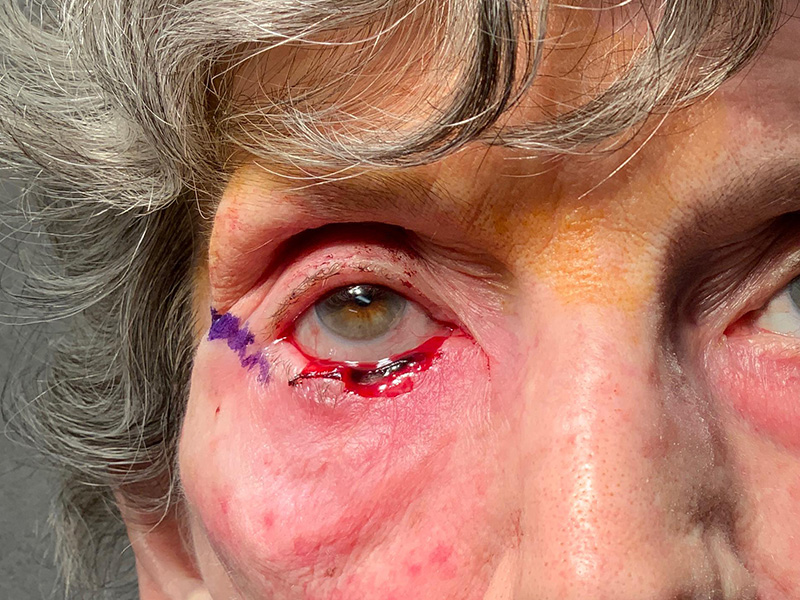 Skin Cancer Reconstruction Before and After | Montilla Plastic Surgery