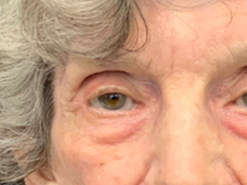 Skin Cancer Reconstruction Before and After | Montilla Plastic Surgery