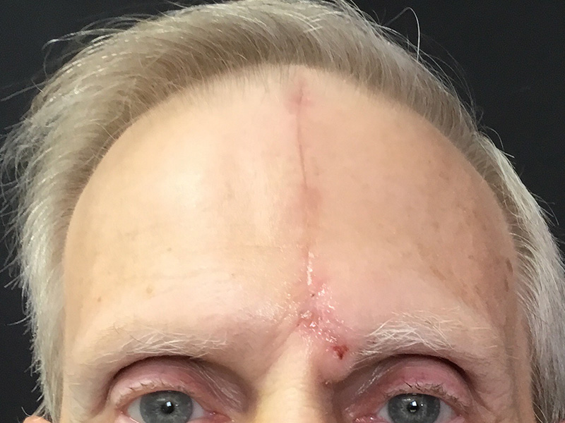 Skin Cancer Reconstruction Before and After | Montilla Plastic Surgery