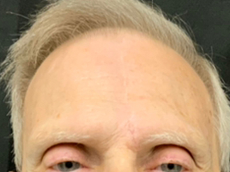 Skin Cancer Reconstruction Before and After | Montilla Plastic Surgery