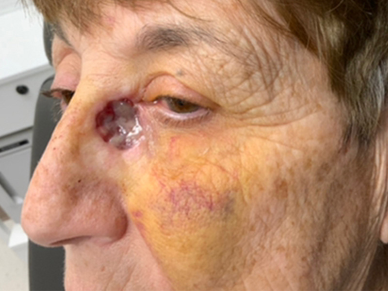 Skin Cancer Reconstruction Before and After | Montilla Plastic Surgery