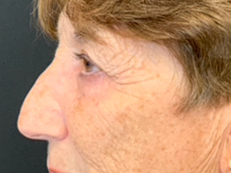 Skin Cancer Reconstruction Before and After | Montilla Plastic Surgery