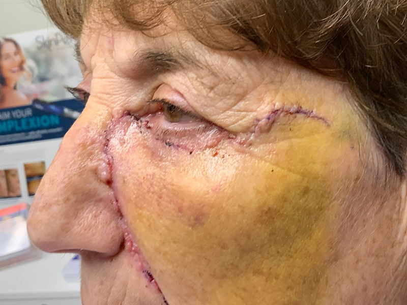 Skin Cancer Reconstruction Before and After | Montilla Plastic Surgery