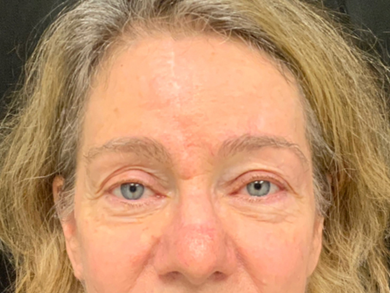 Skin Cancer Reconstruction Before and After | Montilla Plastic Surgery