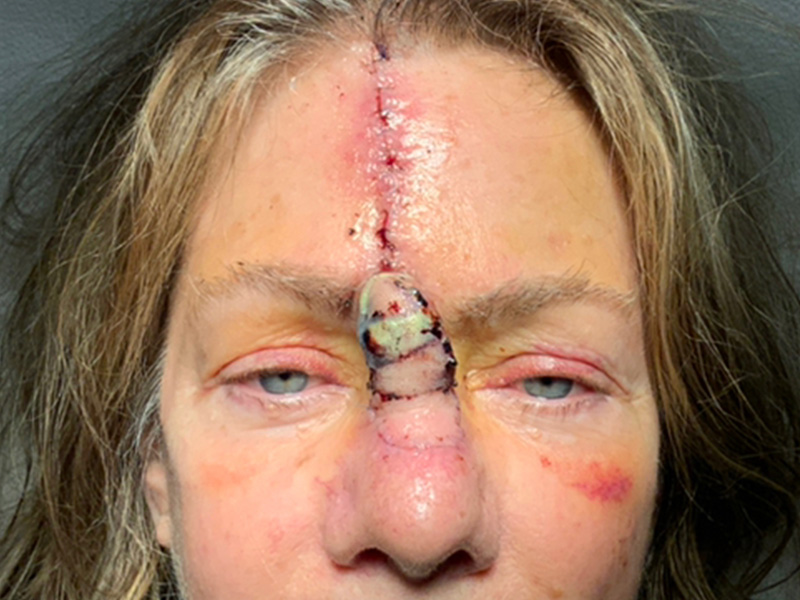 Skin Cancer Reconstruction Before and After | Montilla Plastic Surgery