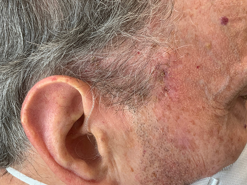 Skin Cancer Reconstruction Before and After | Montilla Plastic Surgery