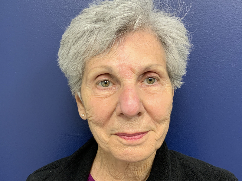 Skin Cancer Reconstruction Before and After | Montilla Plastic Surgery