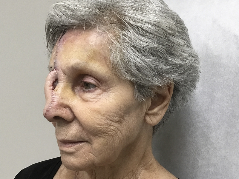 Skin Cancer Reconstruction Before and After | Montilla Plastic Surgery