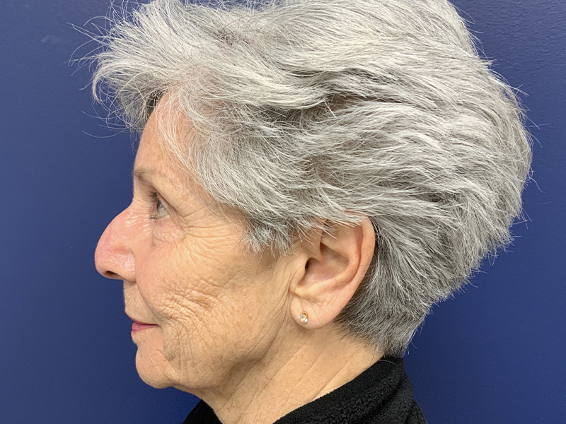 Skin Cancer Reconstruction Before and After | Montilla Plastic Surgery