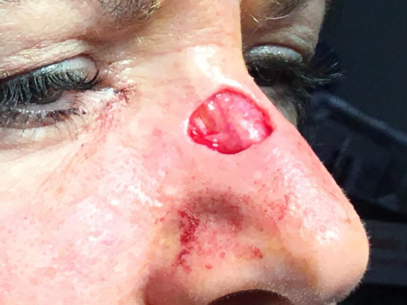 Skin Cancer Reconstruction Before and After | Montilla Plastic Surgery