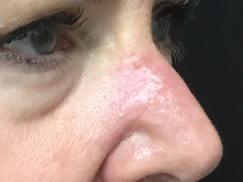 Skin Cancer Reconstruction Before and After | Montilla Plastic Surgery