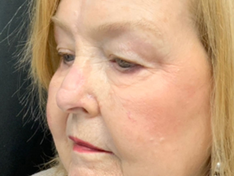 Skin Cancer Reconstruction Before and After | Montilla Plastic Surgery