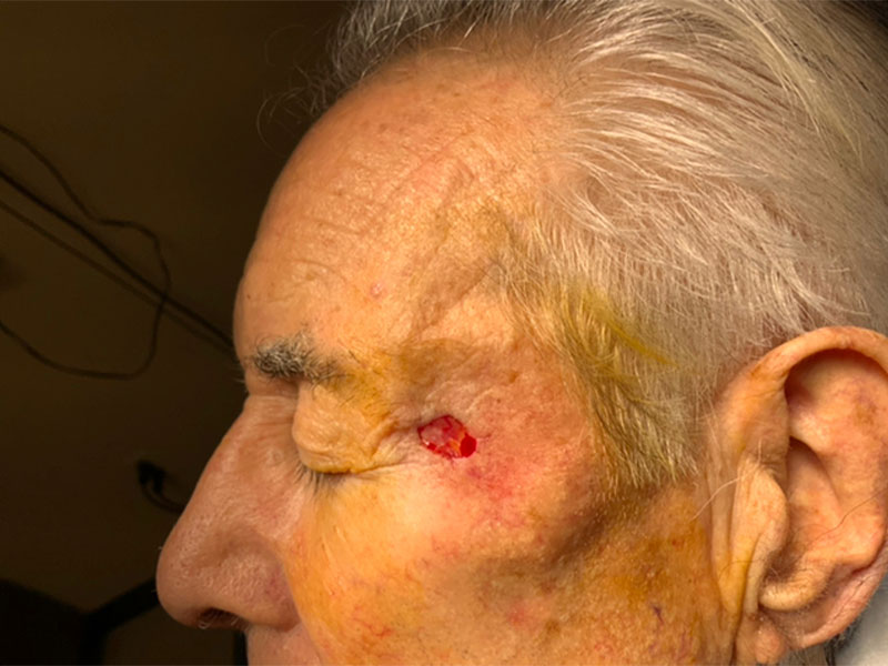 Skin Cancer Reconstruction Before and After | Montilla Plastic Surgery