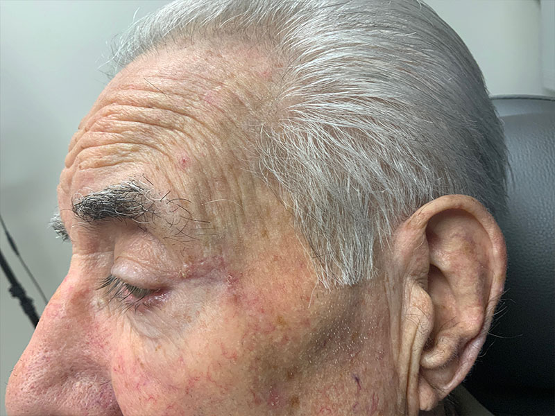 Skin Cancer Reconstruction Before and After | Montilla Plastic Surgery