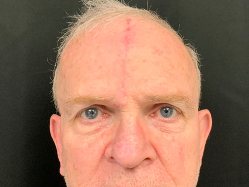 Skin Cancer Reconstruction Before and After | Montilla Plastic Surgery