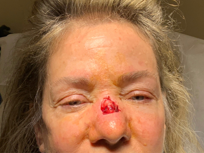 Skin Cancer Reconstruction Before and After | Montilla Plastic Surgery