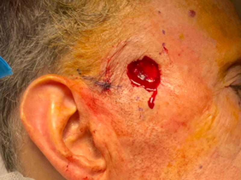 Skin Cancer Reconstruction Before and After | Montilla Plastic Surgery