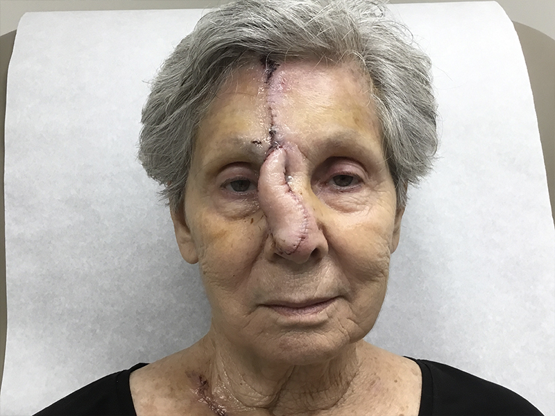 Skin Cancer Reconstruction Before and After | Montilla Plastic Surgery