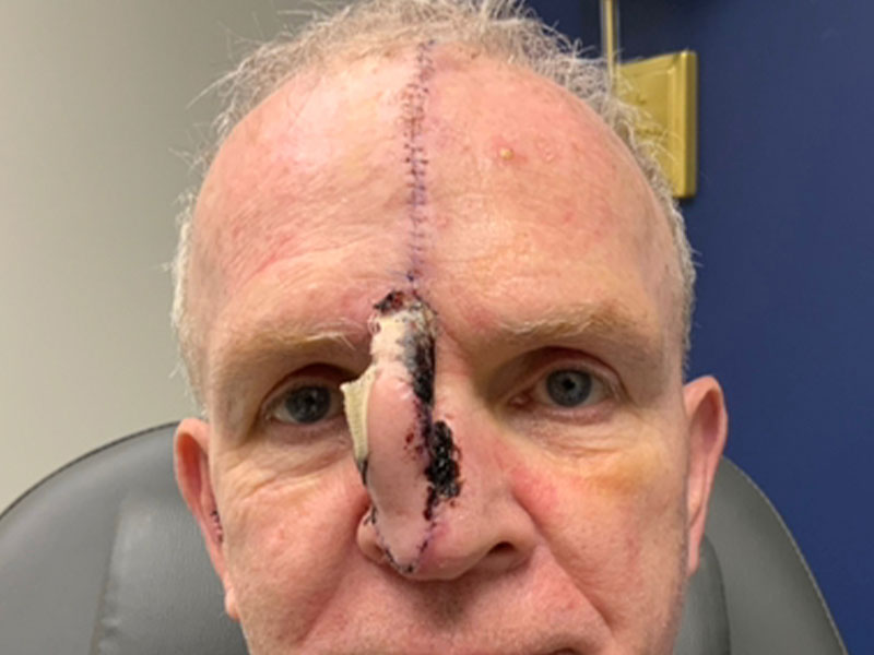 Skin Cancer Reconstruction Before and After | Montilla Plastic Surgery
