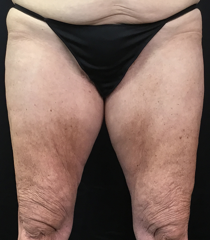 Thigh Lift Before and After | Montilla Plastic Surgery