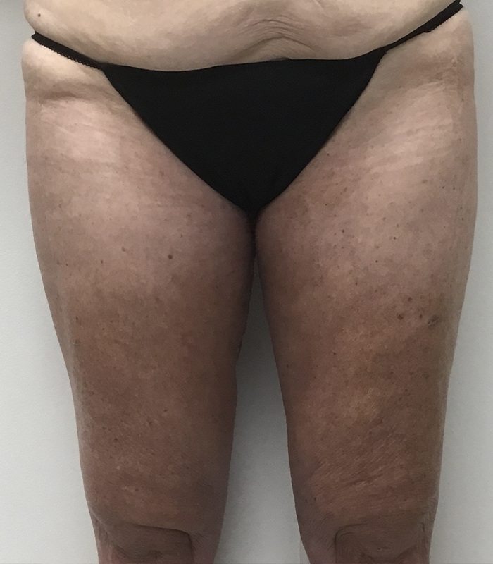 Thigh Lift Before and After | Montilla Plastic Surgery